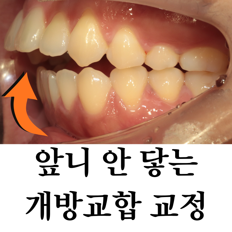  노원역 치아교정, 개방교합·무턱 교정 핵심 포인트