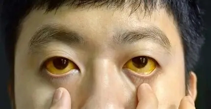황달[jaundice] 은 무엇인가?!