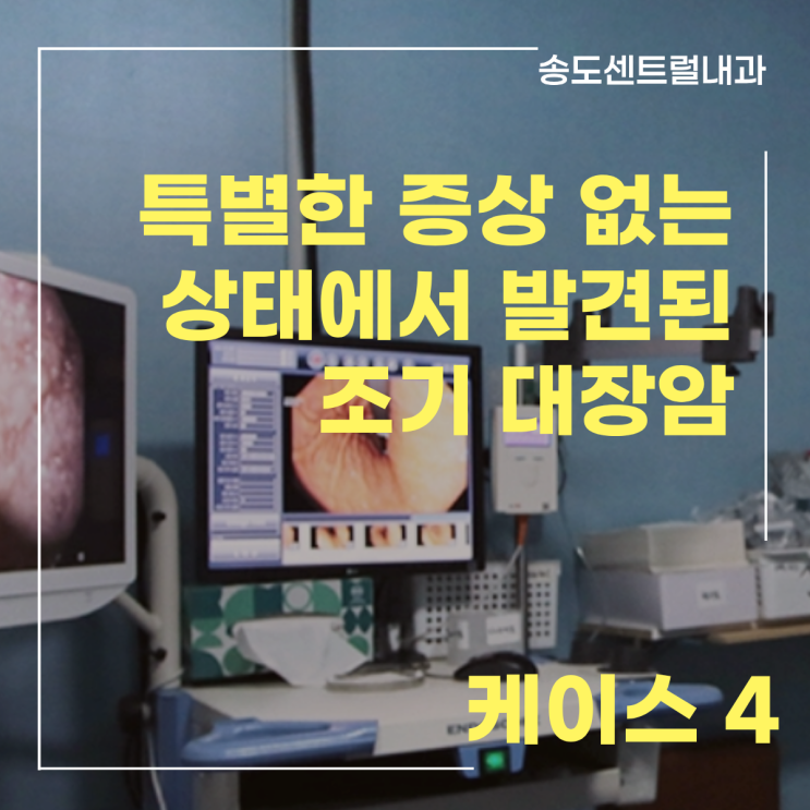  [케이스] 아무 증상 없던 50대 여성, 대장내시경에서 발견된 조기 대장암