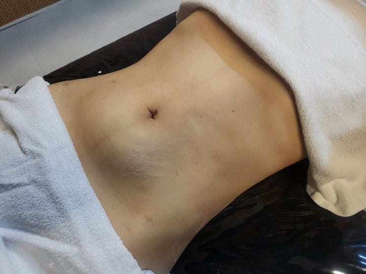  복부 지방흡입 바본, 왜 생기고 언제 풀릴까요? 회복 과정 정리