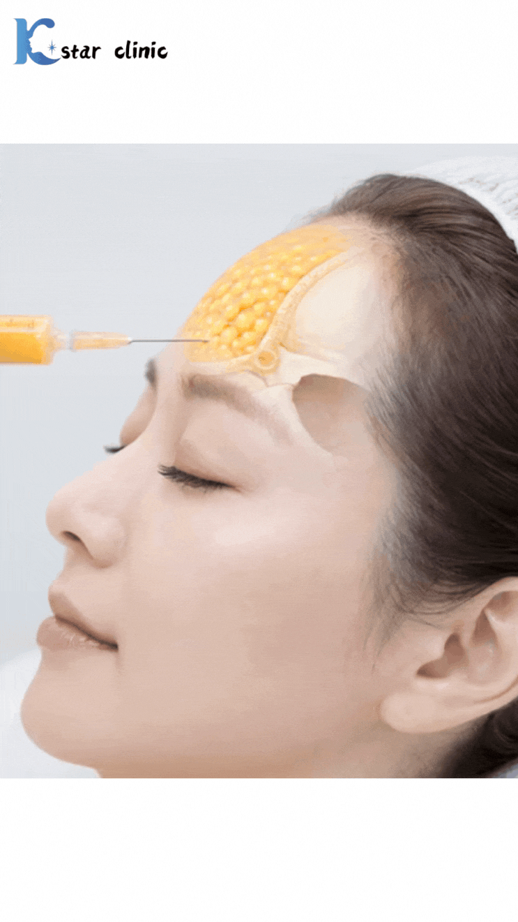  광주지방이식, 이마 볼륨 하나로 얼굴 인상이 달라진다?(수완피부과 기준)
