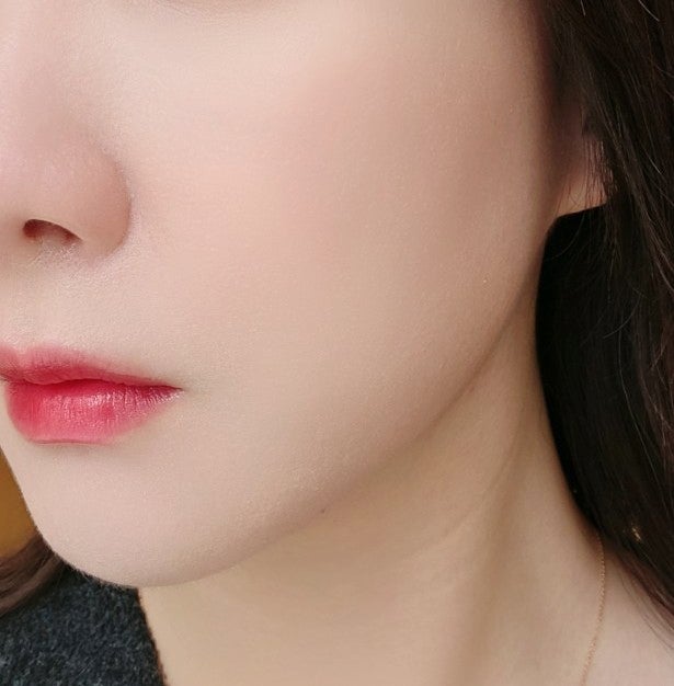  서울 시청역피부과 리쥬란힐러 2CC 가격 후기