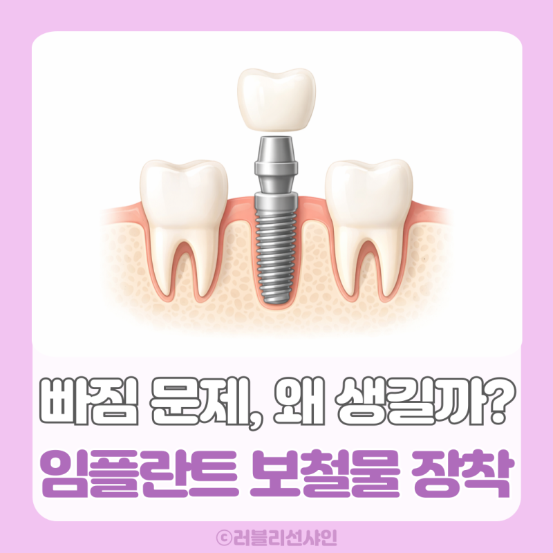 임플란트 보철물 장착 과정부터 종류까지, 보철 빠짐 문제는 왜 생길까?