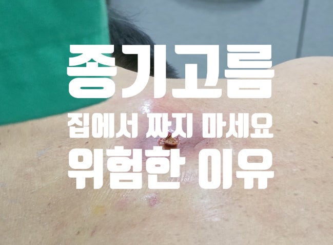  청주 종기고름 집에서 짜기 절대 안되는 의학적 이유