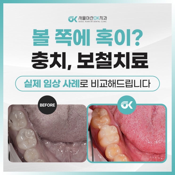  [임상사례]남양주 충치치과, 볼 쪽에 혹이 느껴져요..