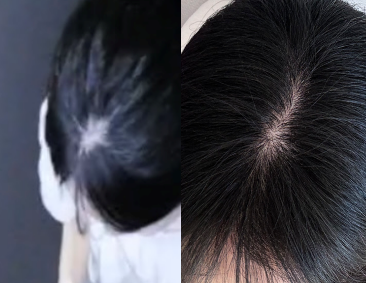  휴지기 탈모 완치 후기ㅣ탈모앰플 샴푸 추천(내돈내산)