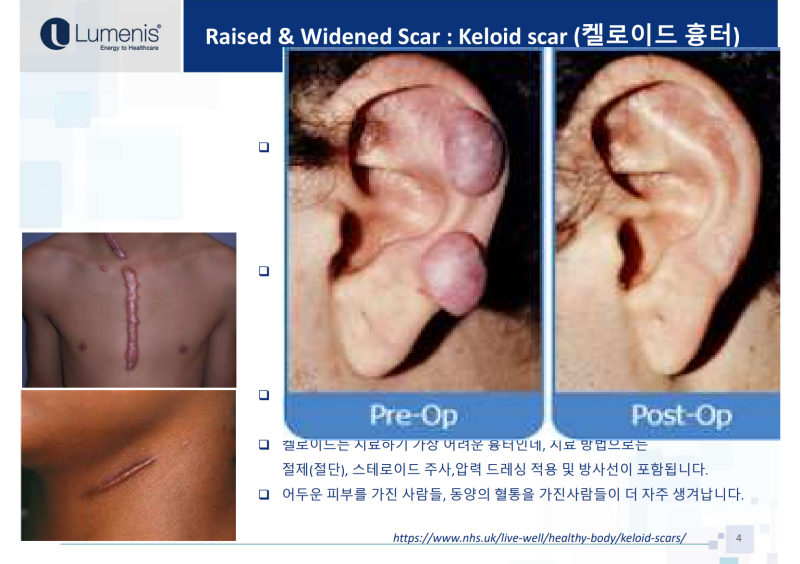 대구켈로이드 주사만으론 부족한 이유? 재발 잡고 비용 아끼는 복합 치료의 비밀