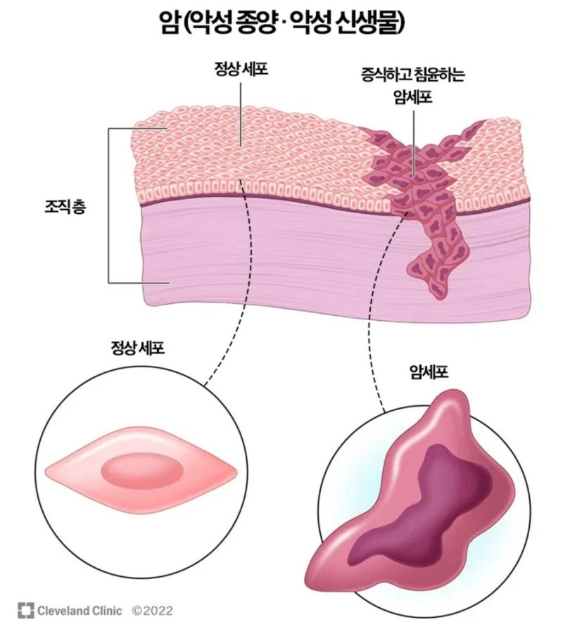 제자리암, 상피내암, 제자리암 부위별 예후