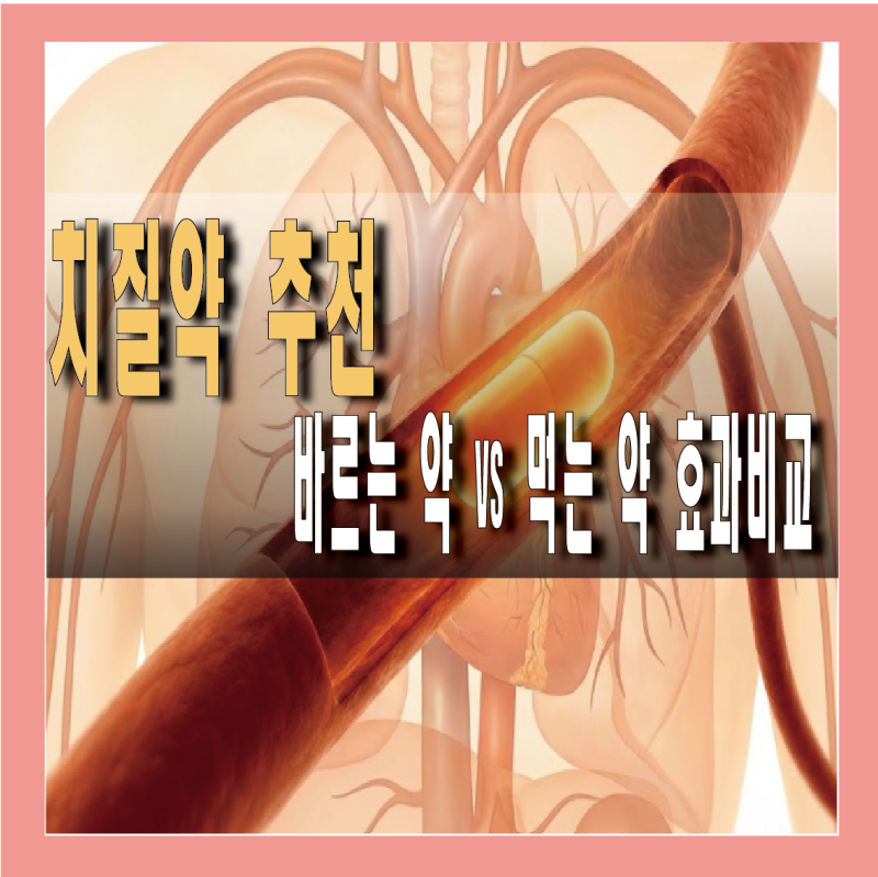 치질약 추천, 먹는 약과 바르는 연고 효과 비교 3가지
