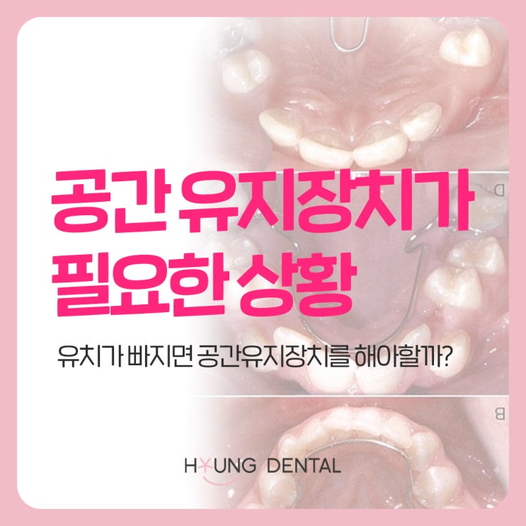  발치 후 공간유지장치? 수원 어린이 교정치과에서 알려드려요