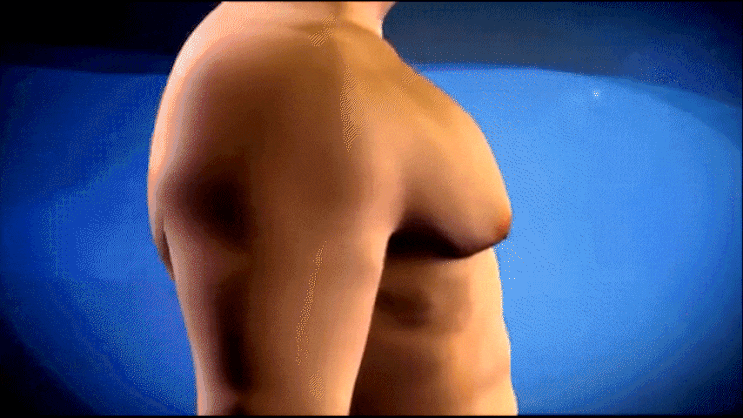  부산 여유증 수술, 흉터 걱정되시죠? 절개 위치가 다릅니다