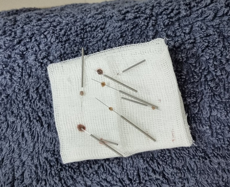  얼굴 점빼기 가격 레이저 재발점 몸점 제거 후 관리