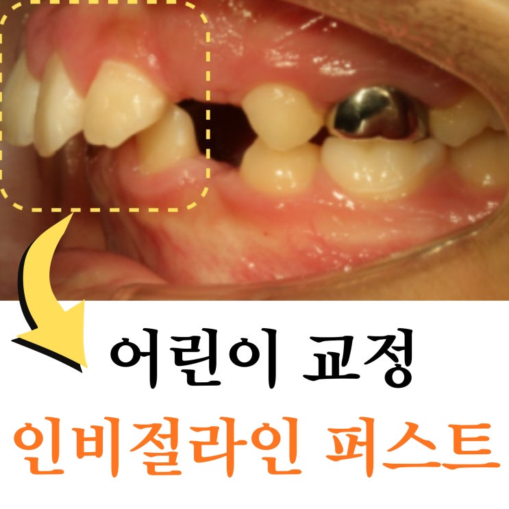  상계동어린이교정, 인비절라인 퍼스트 적용 기준