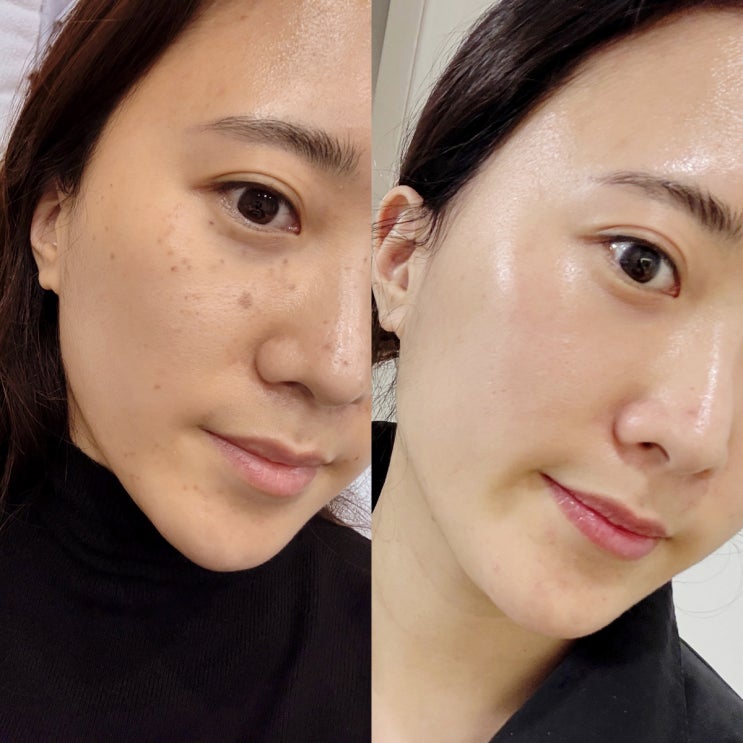  종로피부과 흑자 기미제거 해결 아꼴레이드 토닝레이저 후기