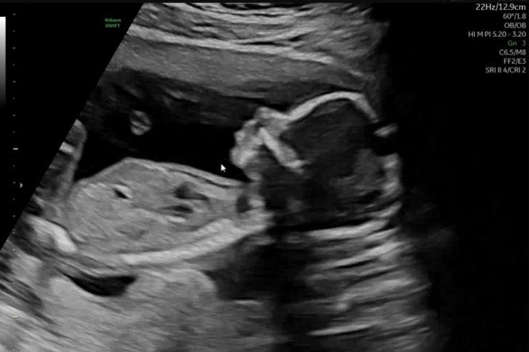  [임신 일기] 13주~22주, 임신 중기 전반부, 입덧이 끝났어요! (+임신 중기 증상 및 할 일)