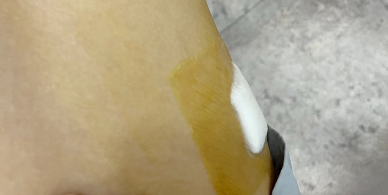 낭종 제거 수술 후기, 피지낭종, 표피낭종 증상
