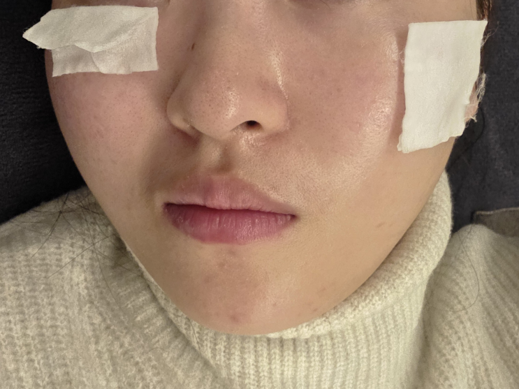  패인흉터 제거 수원한의원 새살침 2회차 후기