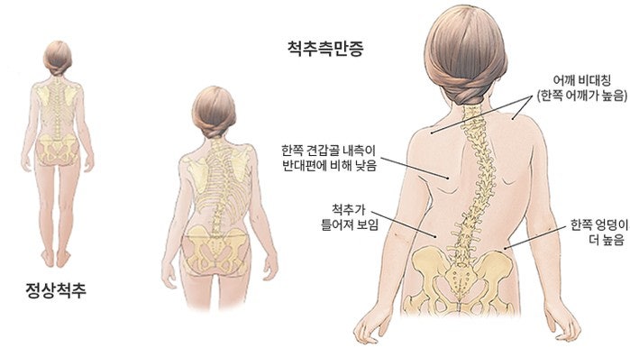  부산 중학생 척추측만증-성장치료보다 자세교정으로 키성장 잡아보아요!