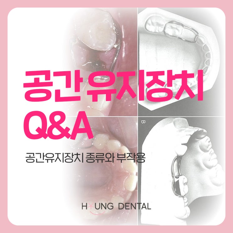  인계동 치과가 말하는 공간유지장치의 모든 것