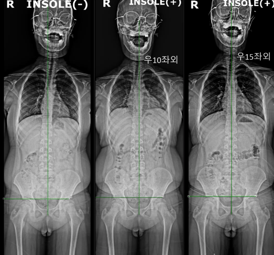 대구척추측만증병원 가도 통증이 그대로라면 수술을 해야 할까? <대학병원 출신 전문의 답변....