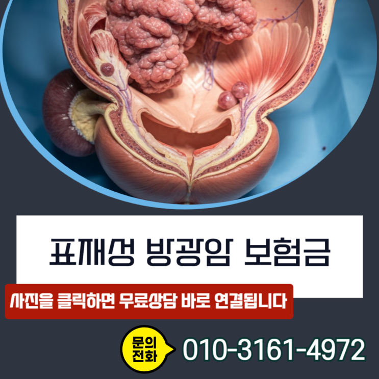  표재성 방광암 보험금 거절 통보후 전액 보상받은 핵심 비책