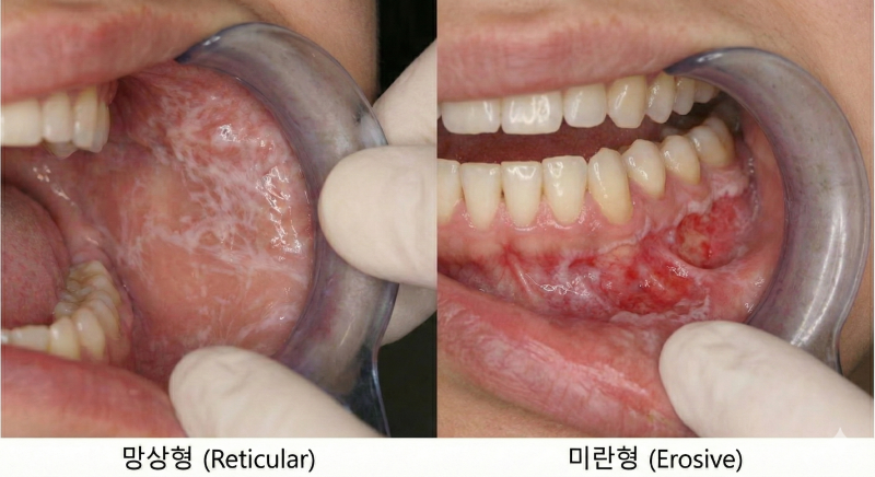 입안이 화끈거리고 하얀 그물망이 보인다면? [구강편평태선]