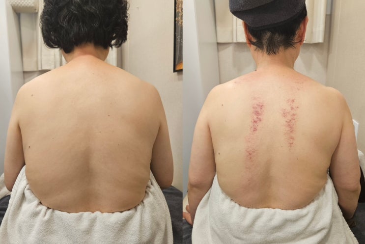  동대문구 순환관리 받고 어깨라인이 달라졌어요,[올가드림뷰티 전농점]후기