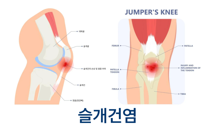 무릎 앞쪽이 찌릿하다면? 점퍼스 니(Jumper's knee, 슬개건염) 부산무릎재활치료 병원
