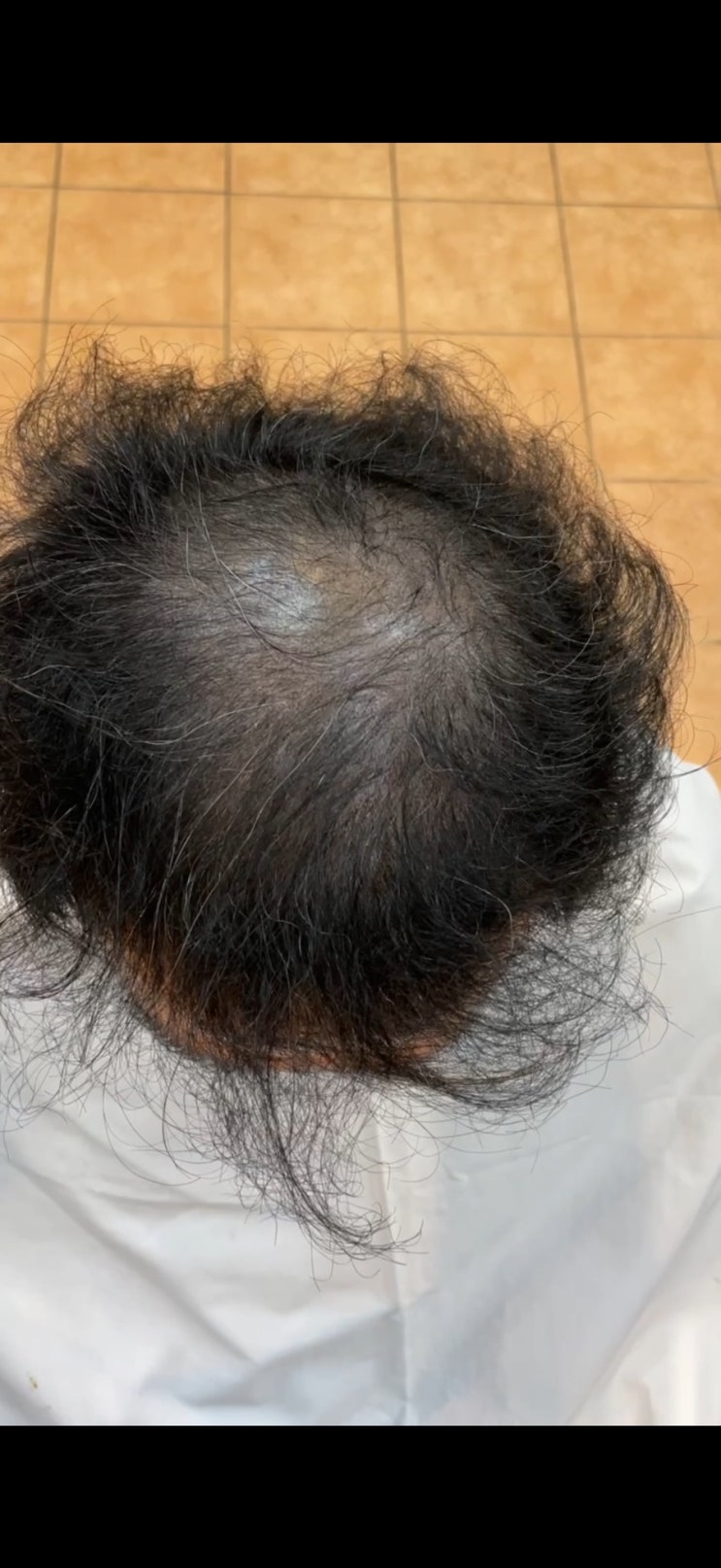  두피페인팅 후회하시나요? "칠해도 안 가려지는 텅 빈 정수리, 부산 탈모 성지에서 찾은 '성형펌'의 기적 (ft. 두피페인팅 단점 극복)"