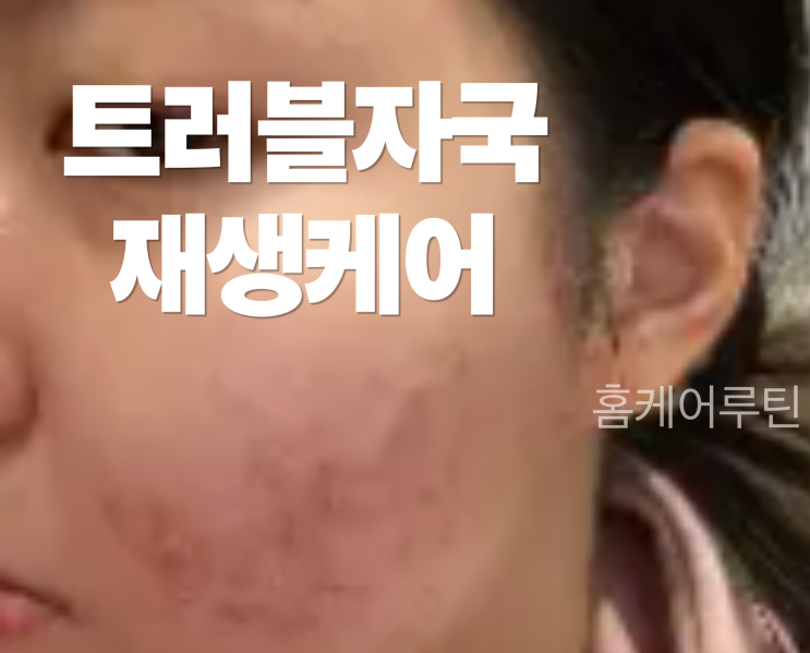  트러블 자국 항산화 케어, 마스크 트러블 이후 남은 자국 얼마나 옅어졌을까?