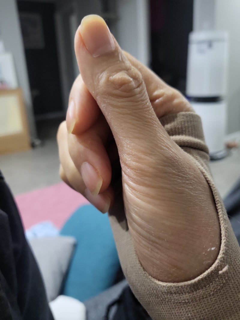손목골절수술후 두달째 만6주 통증 외래후기