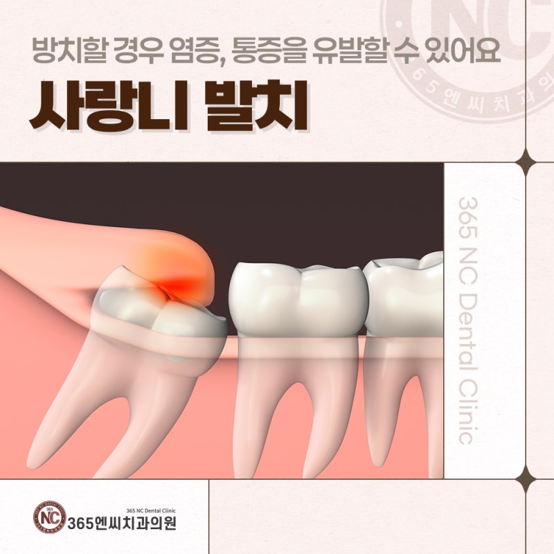 마산사랑니발치 필수일까? 시술후 주의사항도 알려드려요