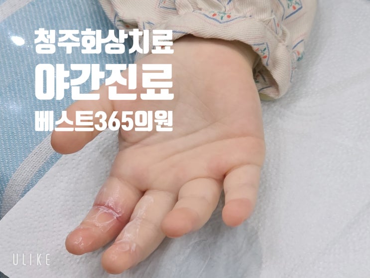  청주 야간진료 화상치료 레이저 없이 흉터 최소화가 가능한 이유