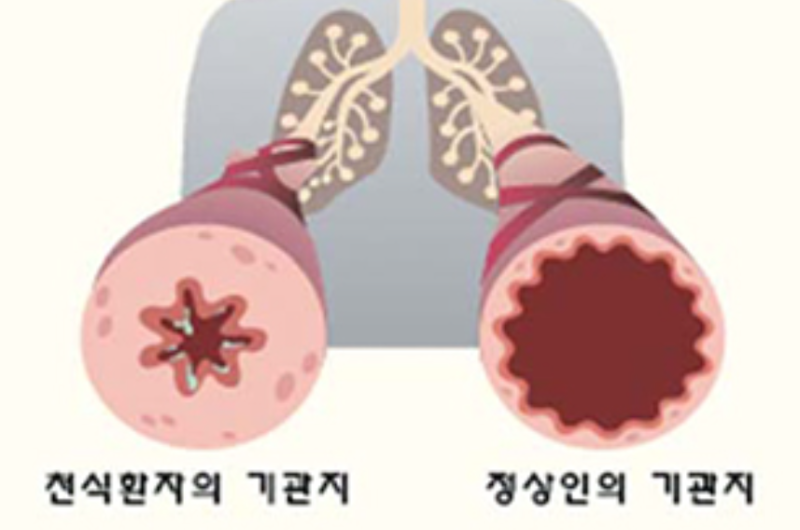 천식 뜻 완치 전염 증