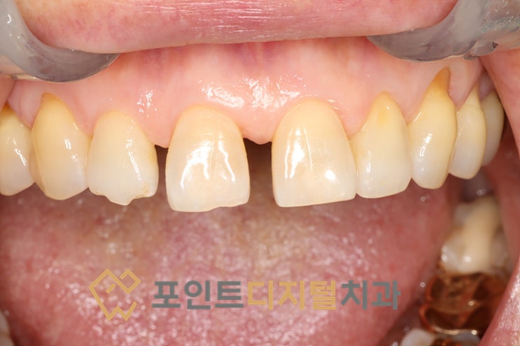  [탕정치과]  앞니 벌어짐(Diastema) 레진 치료 / 천안 아산 불당 배방