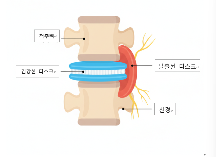  목·허리디스크, 당신의 척추는 안녕한가요? 일상 속 통증, 이제는 작별할 시간! 