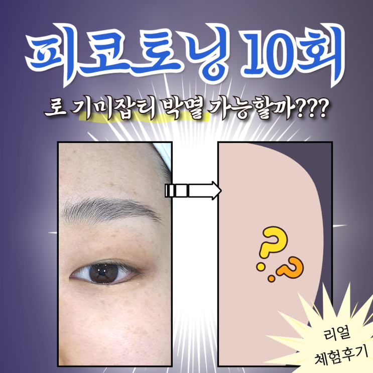  아비쥬 노원점 내돈내산 후기｜피코토닝 10회권 [1-3회차]