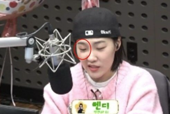   가요광장 이은지 눈에 시퍼런 멍?! 생방송 중 밝힌 황당 부상 사연과 현재 상태