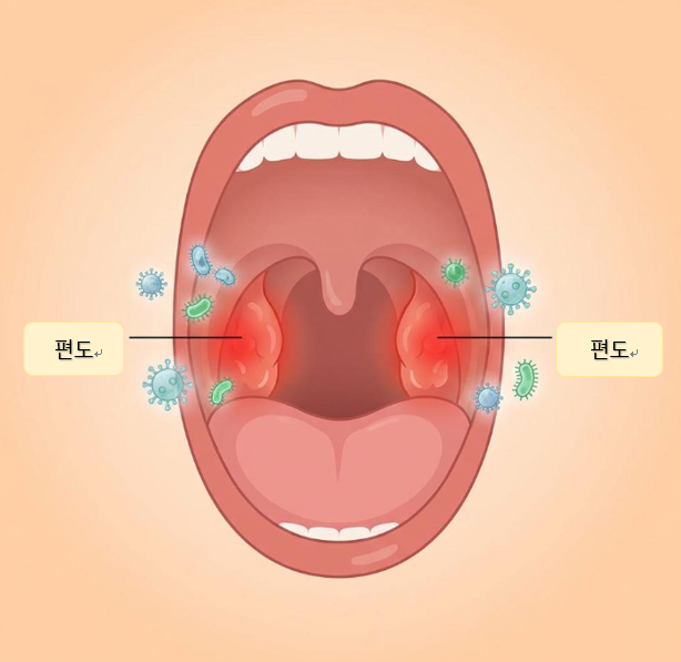   만성 편도염, 이제 그만!원인부터 치료, 예방까지 완벽 가이드 
