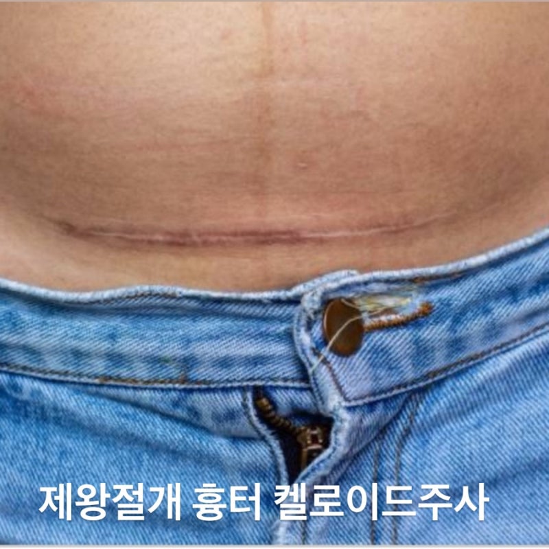 제왕절개 흉터 켈로이드 주사 3번 맞은 후기, 가격 통증 주기 등
