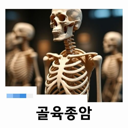 뼈에 생기는 골육종암, 골육종 증상 및 뼈암 치료