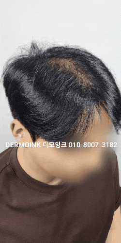  안양 탈모 커버, 정수리 가르마 두피 페인팅으로 볼륨 살아난 후기