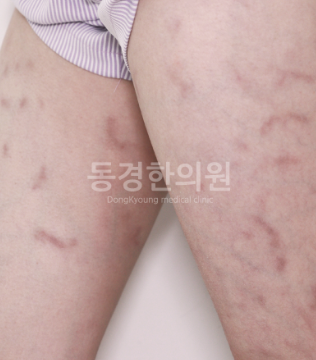 허벅지 안쪽 붉은반점, 피부 문제가 아니다?