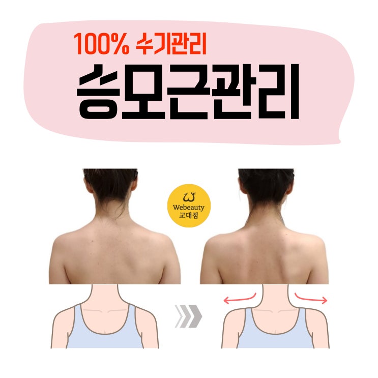  직각 어깨를 위해 승모근 시술을 고민 중이신가요?서초동근처 100% 수기관리