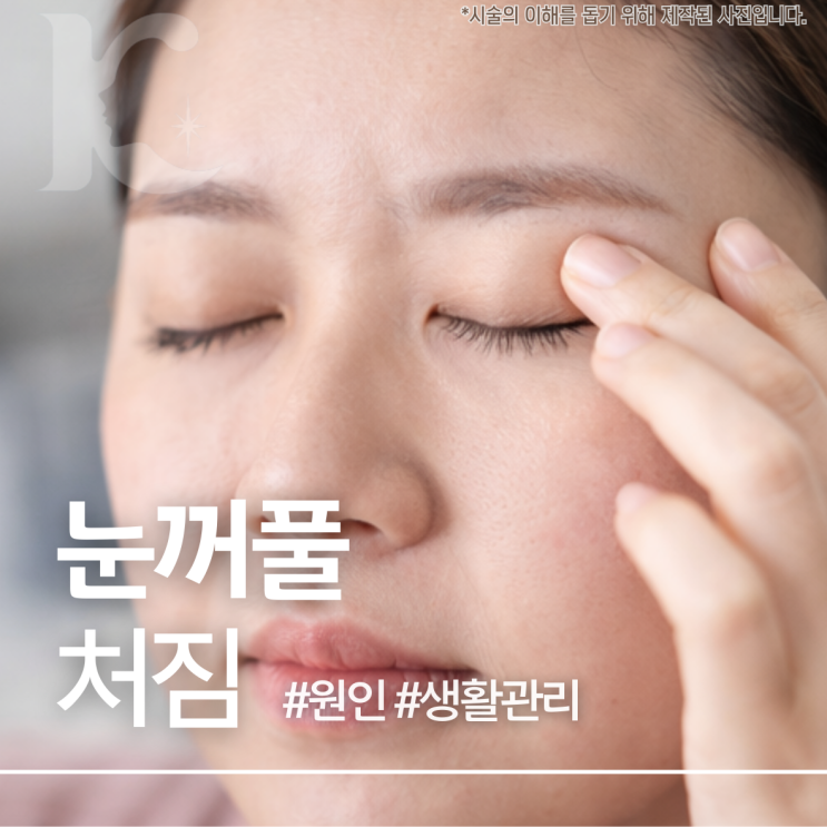  쌍꺼풀 처짐 원인 및 예방 정보 눈꺼풀 늘어짐 왜 생기는 걸까요