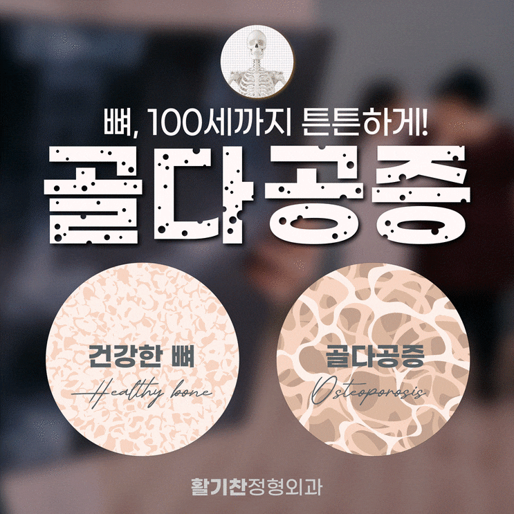  대조동정형외과, 폐경기 여성 골밀도 높이는 식단과 운동