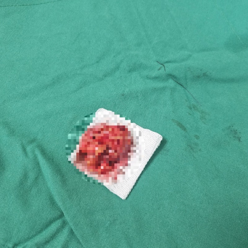 대구 수성구 표피낭종 제거 병원 추천 (경북연합외과의원)