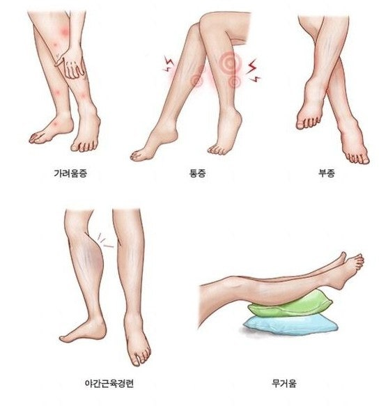 대전 하지정맥류 병원 치료 후기 및 후관리 방법 공유