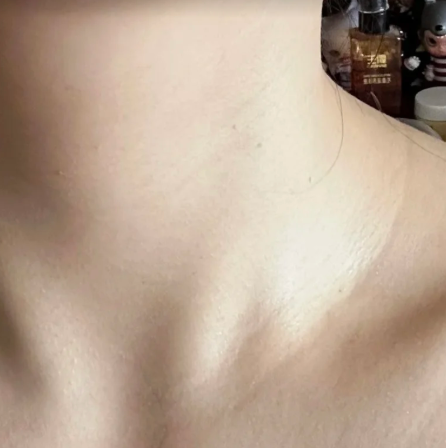  미간주름 없애기 바르는 걸로 정착한 이유