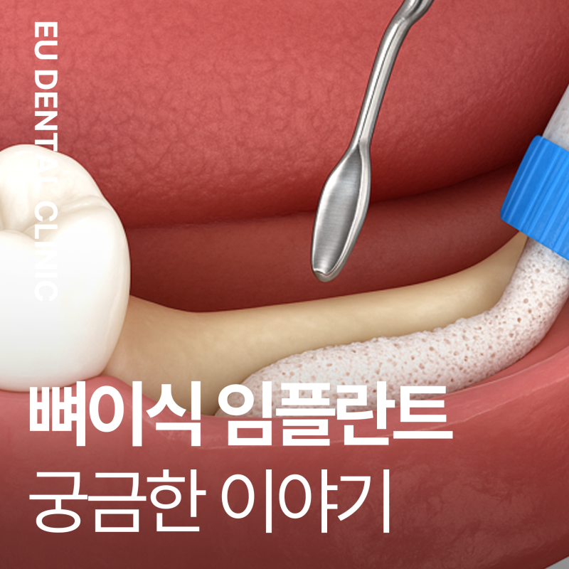 범일역치과 임플란트 뼈이식 후 흡연 음주 중단 7일?
